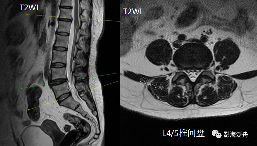 影像PPT - 椎管内硬膜外脂肪增多症-2 影像PPT - 椎管内硬膜外脂肪增多症-2