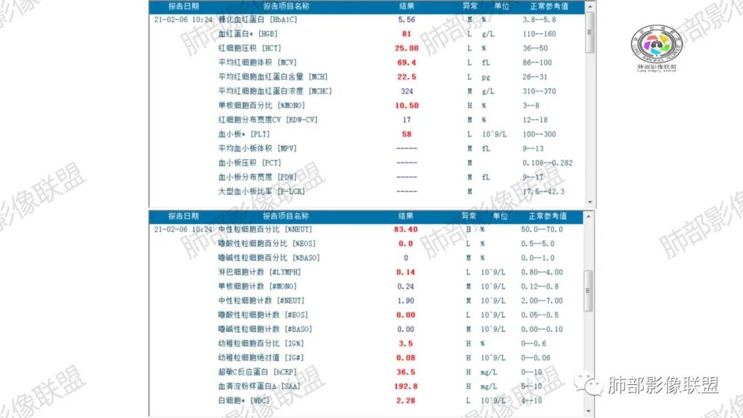 影像PPT - 【病例】马儿尼菲篮状菌1例肺部CT影像-5 影像PPT - 【病例】马儿尼菲篮状菌1例肺部CT影像-5