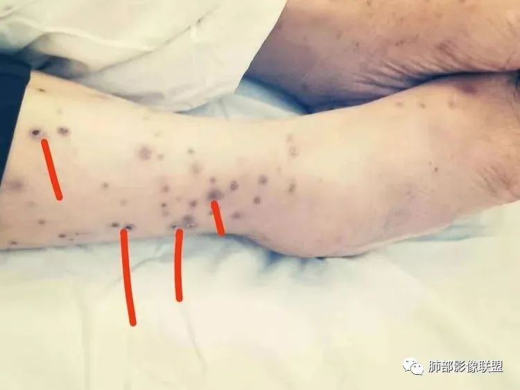 影像PPT - 【病例】马儿尼菲篮状菌1例肺部CT影像-48 影像PPT - 【病例】马儿尼菲篮状菌1例肺部CT影像-48