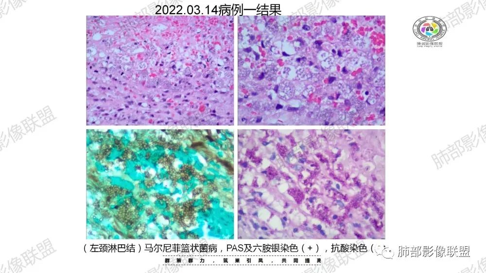 影像PPT - 【病例】马儿尼菲篮状菌1例肺部CT影像-47 影像PPT - 【病例】马儿尼菲篮状菌1例肺部CT影像-47