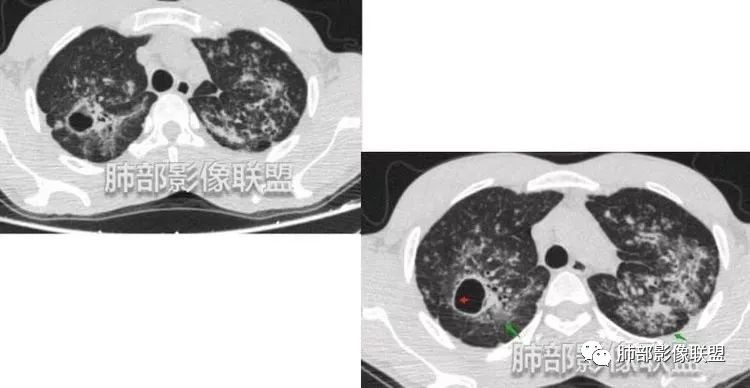 影像PPT - 【病例】马儿尼菲篮状菌1例肺部CT影像-49