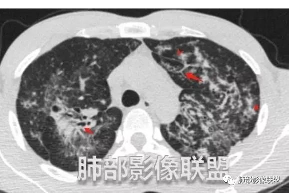 影像PPT - 【病例】马儿尼菲篮状菌1例肺部CT影像-50