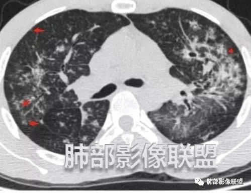影像PPT - 【病例】马儿尼菲篮状菌1例肺部CT影像-52