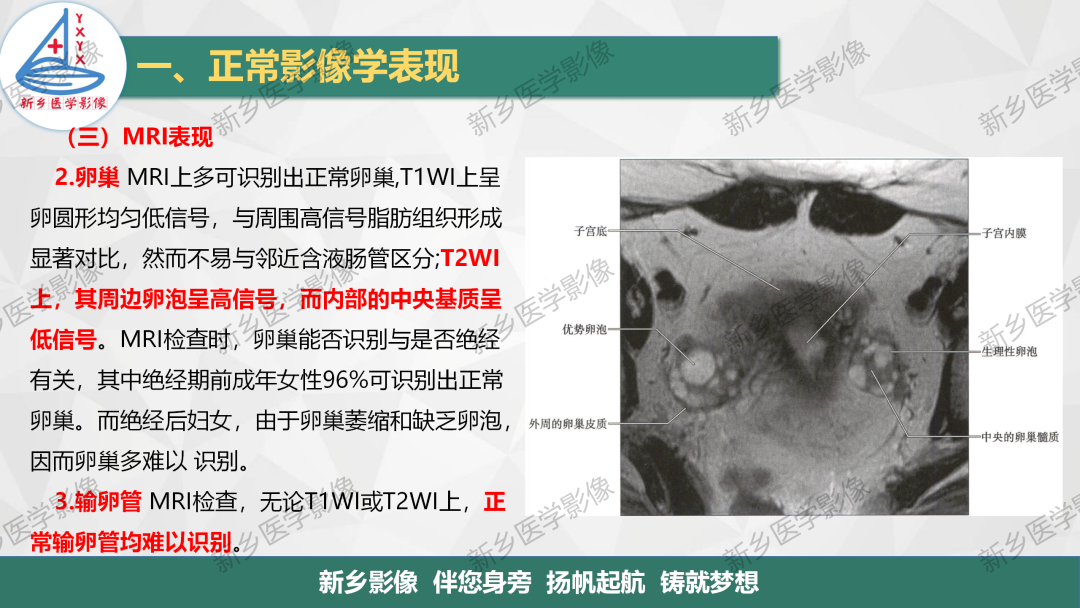 影像PPT - 【PPT】女性生殖解剖、发育畸形影像表现-10