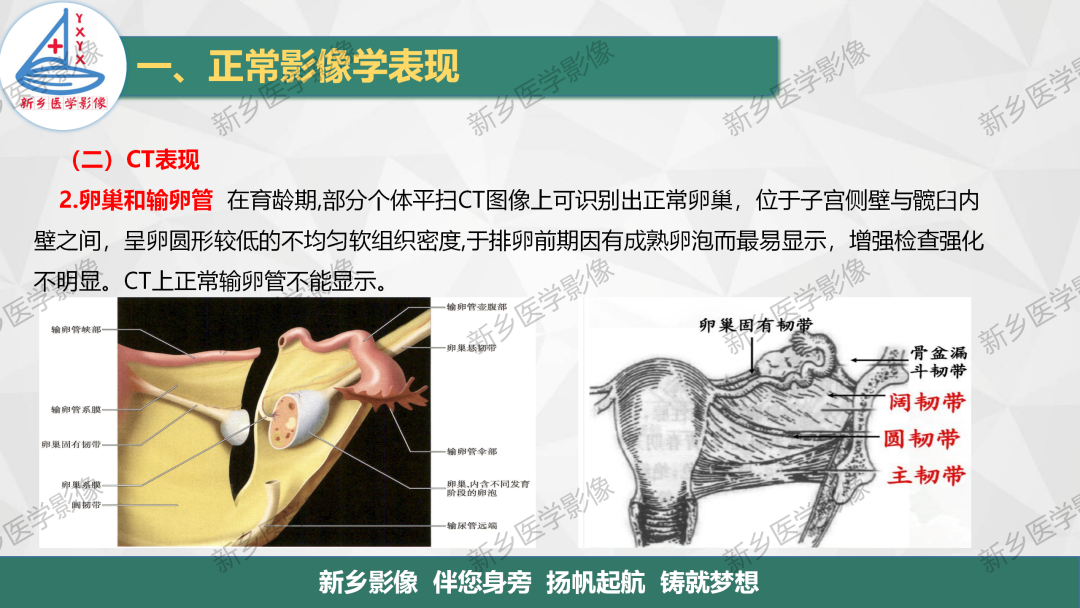 影像PPT - 【PPT】女性生殖解剖、发育畸形影像表现-6