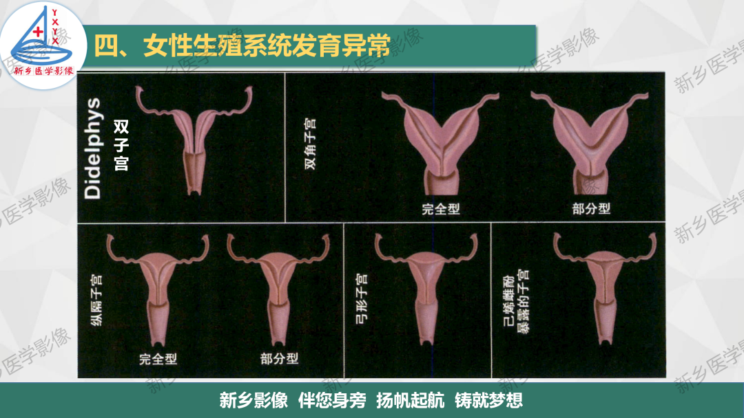影像PPT - 【PPT】女性生殖解剖、发育畸形影像表现-18