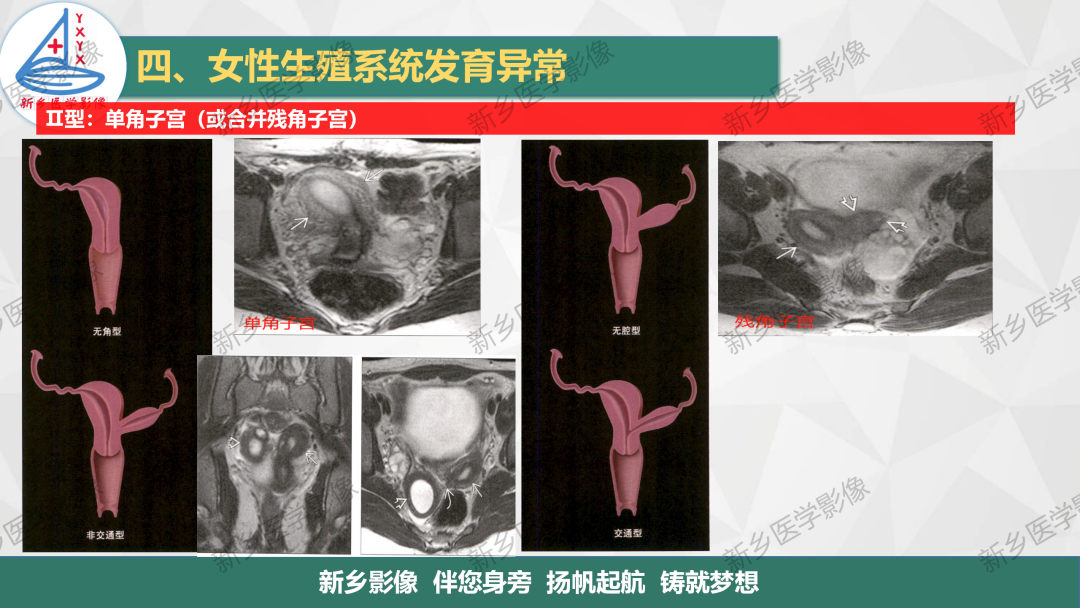 影像PPT - 【PPT】女性生殖解剖、发育畸形影像表现-21