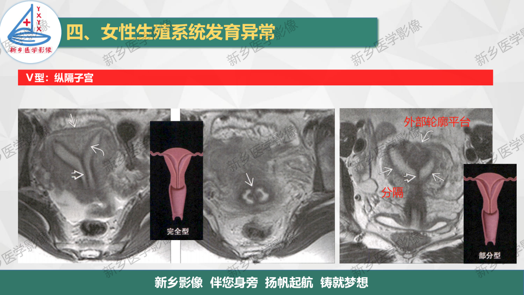 影像PPT - 【PPT】女性生殖解剖、发育畸形影像表现-24
