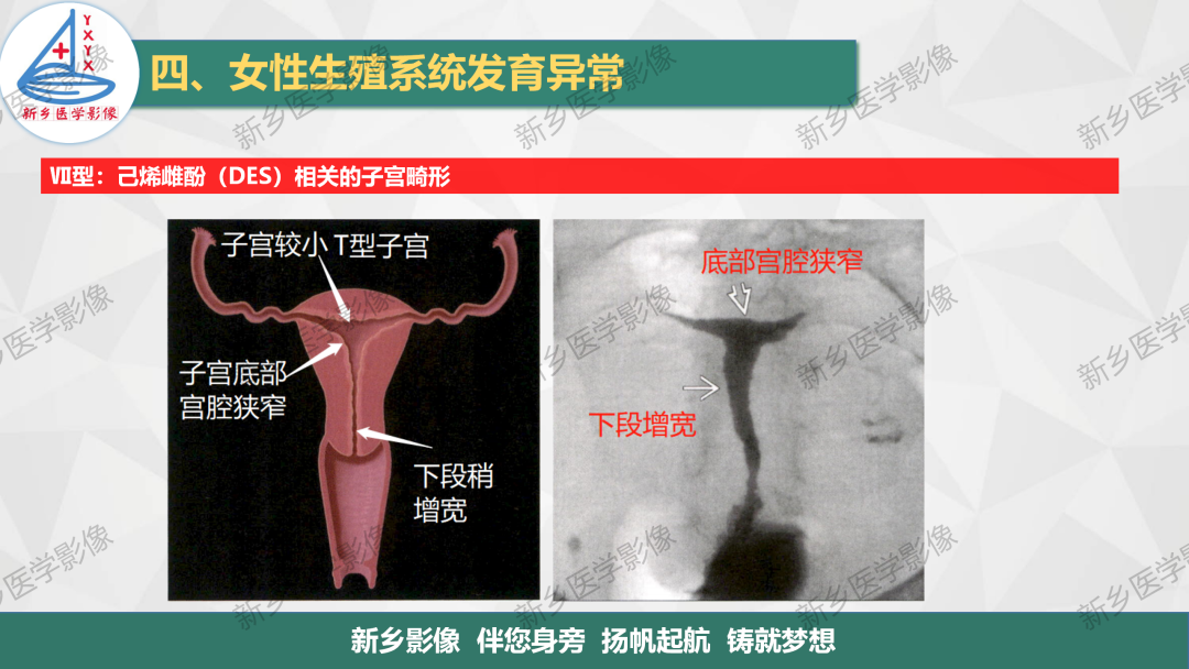 影像PPT - 【PPT】女性生殖解剖、发育畸形影像表现-26