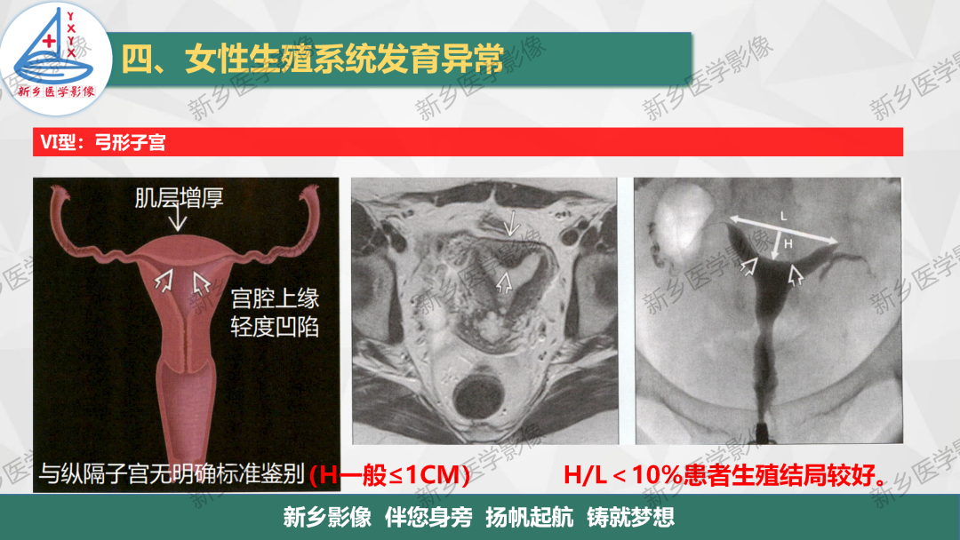影像PPT - 【PPT】女性生殖解剖、发育畸形影像表现-25