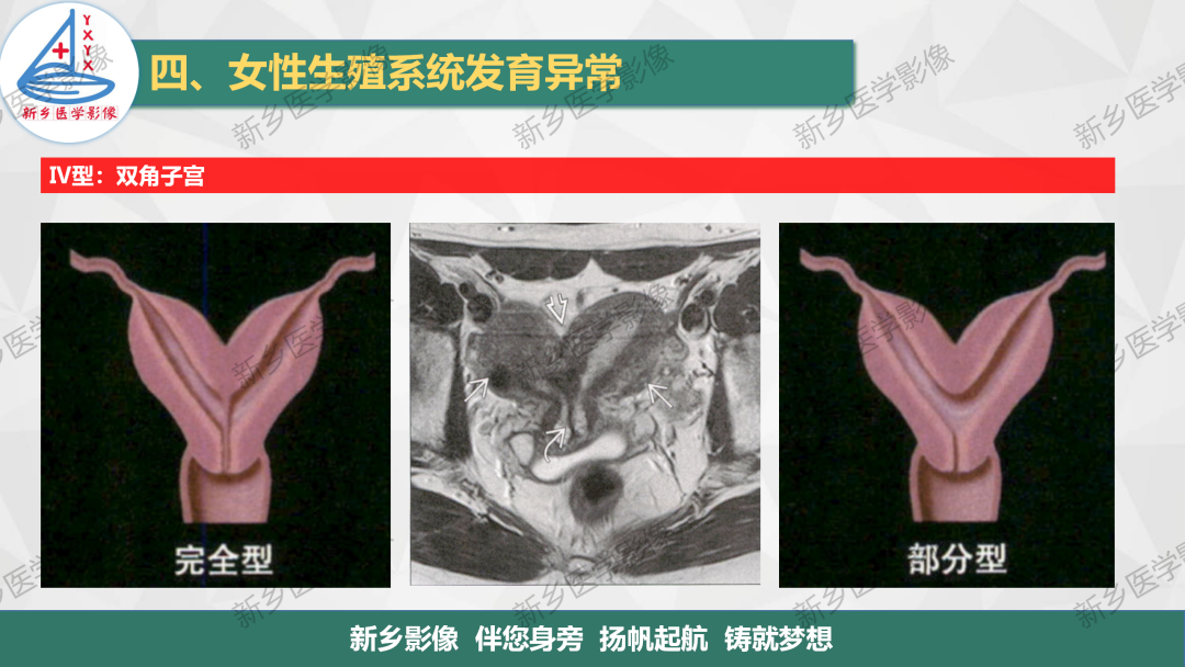 影像PPT - 【PPT】女性生殖解剖、发育畸形影像表现-23