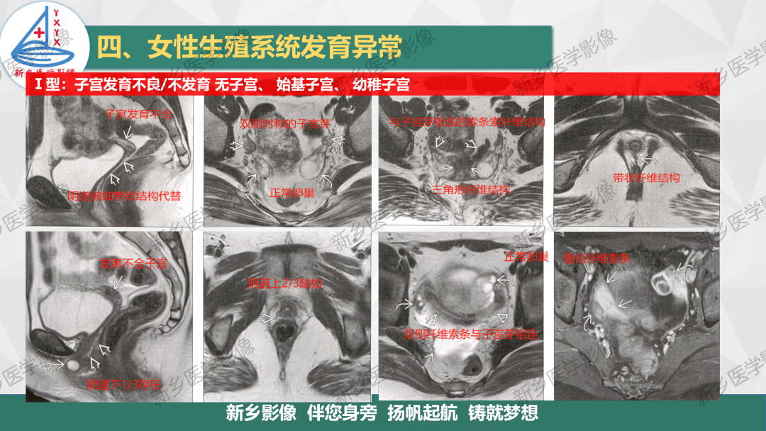 影像PPT - 【PPT】女性生殖解剖、发育畸形影像表现-20