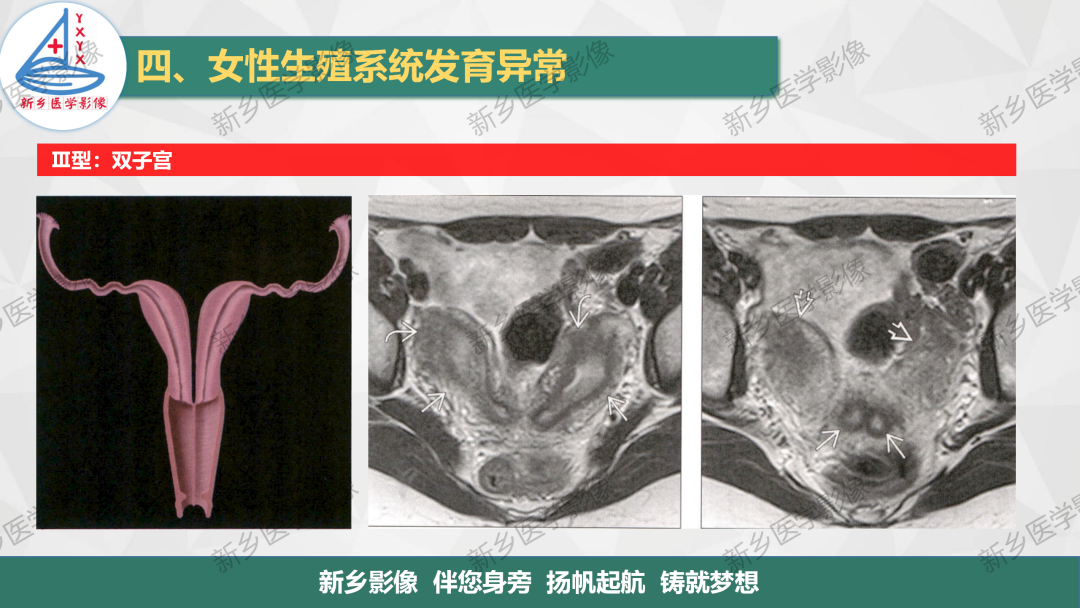 影像PPT - 【PPT】女性生殖解剖、发育畸形影像表现-22