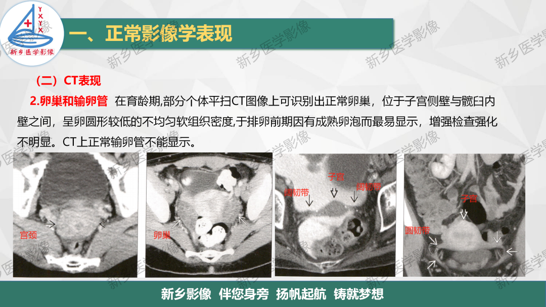 影像PPT - 【PPT】女性生殖解剖、发育畸形影像表现-7