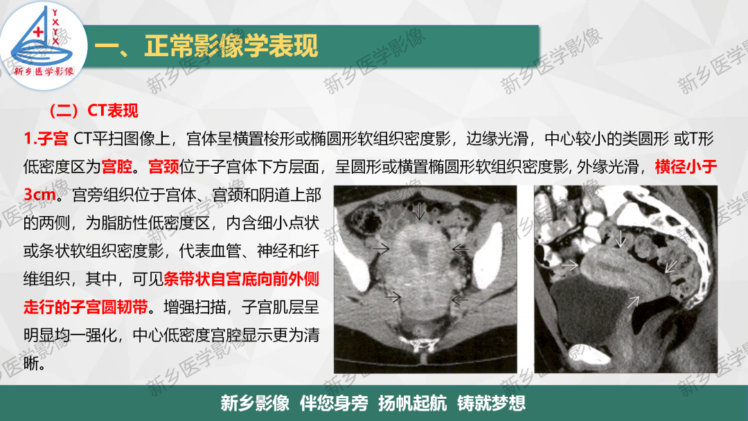 影像PPT - 【PPT】女性生殖解剖、发育畸形影像表现-5