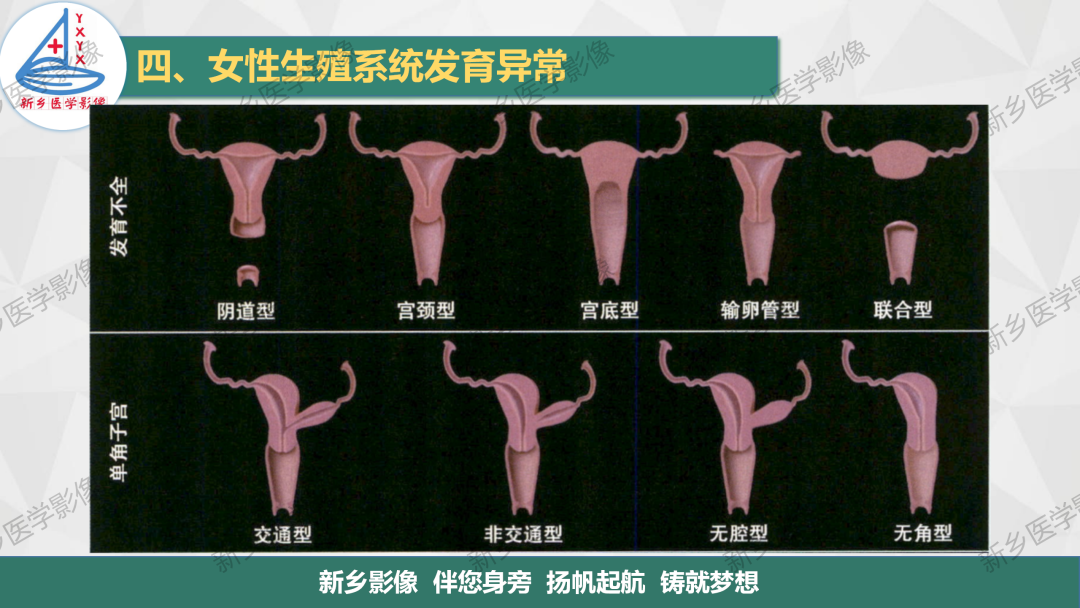 影像PPT - 【PPT】女性生殖解剖、发育畸形影像表现-17