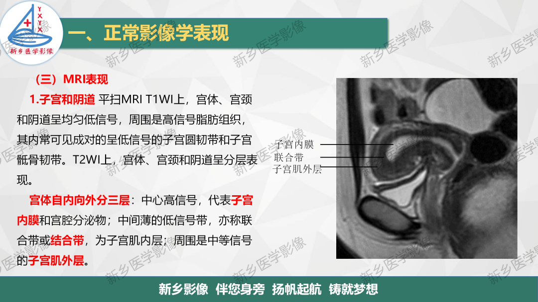 影像PPT - 【PPT】女性生殖解剖、发育畸形影像表现-3
