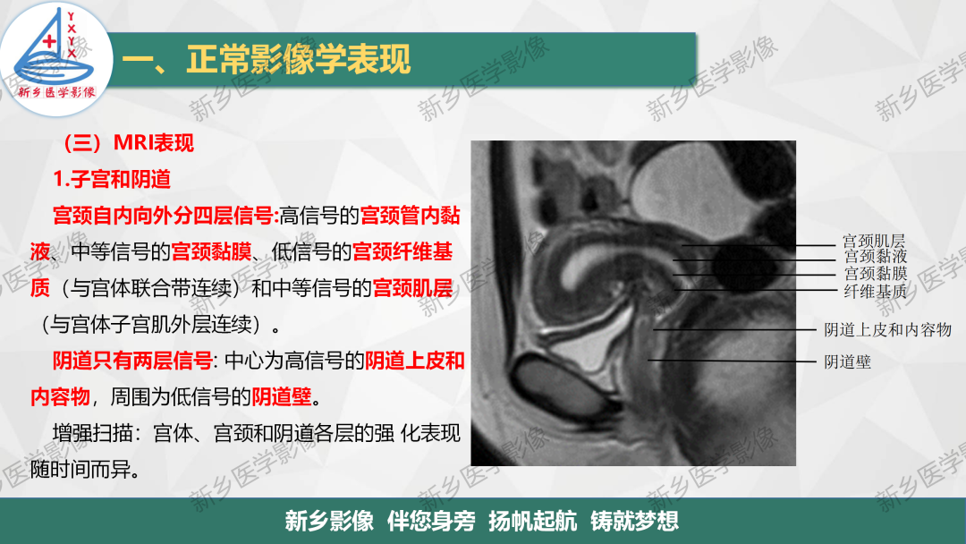 影像PPT - 【PPT】女性生殖解剖、发育畸形影像表现-4