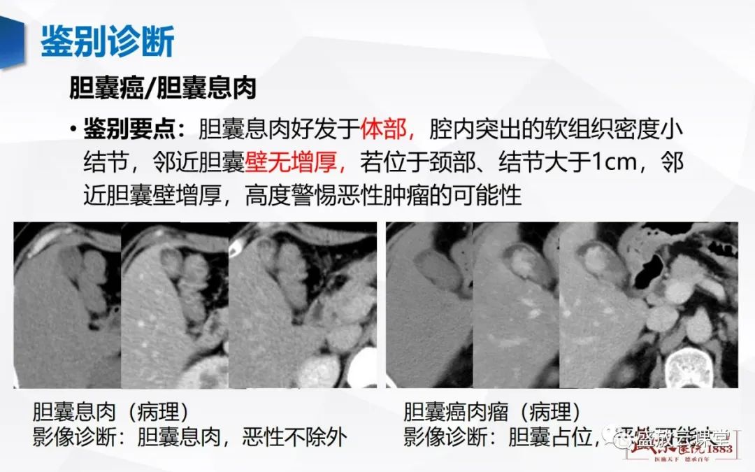 影像PPT - 【病例】胆囊癌及肝门部胆管癌各1例CT影像-9
