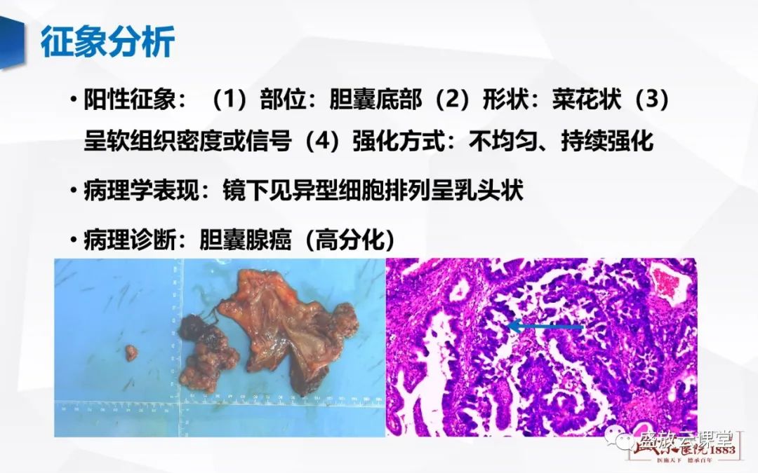 影像PPT - 【病例】胆囊癌及肝门部胆管癌各1例CT影像-6