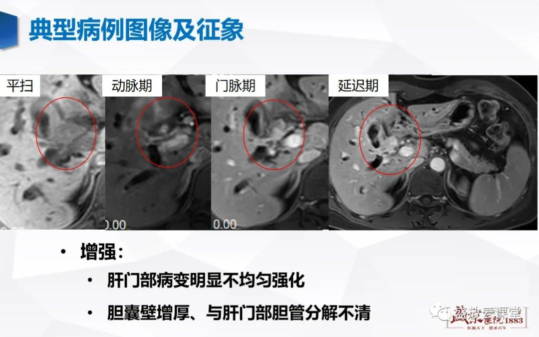 影像PPT - 【病例】胆囊癌及肝门部胆管癌各1例CT影像-16