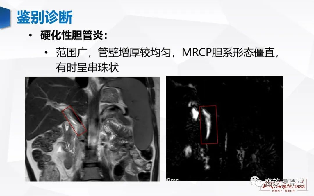 影像PPT - 【病例】胆囊癌及肝门部胆管癌各1例CT影像-21