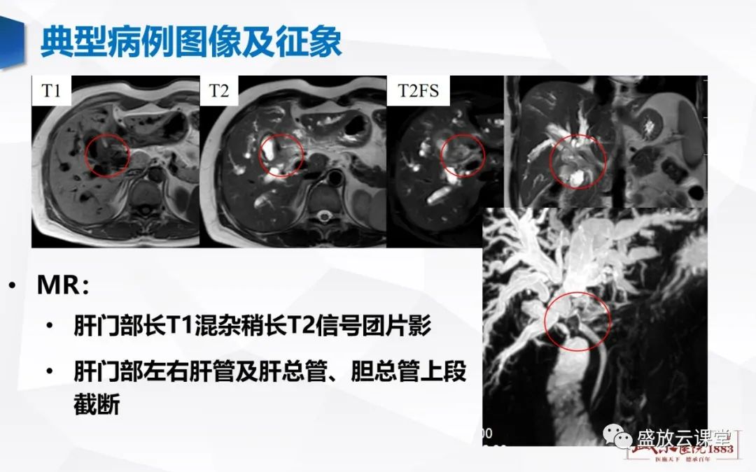 影像PPT - 【病例】胆囊癌及肝门部胆管癌各1例CT影像-15