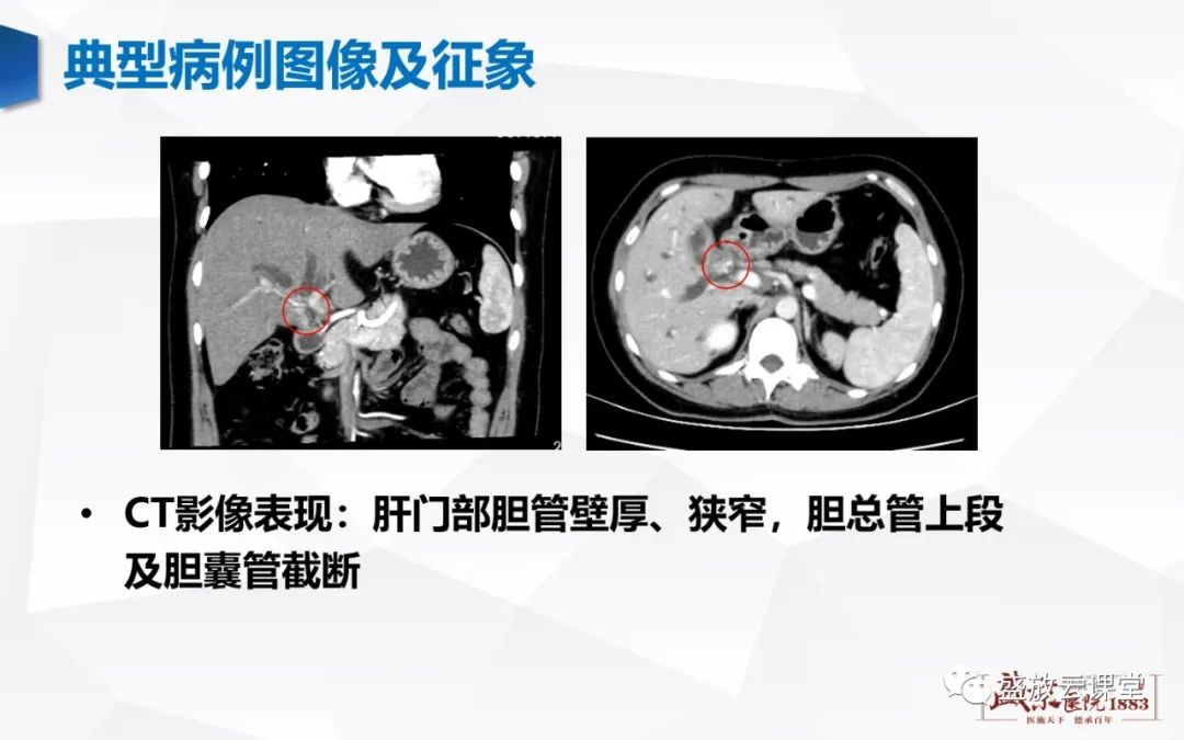 影像PPT - 【病例】胆囊癌及肝门部胆管癌各1例CT影像-14