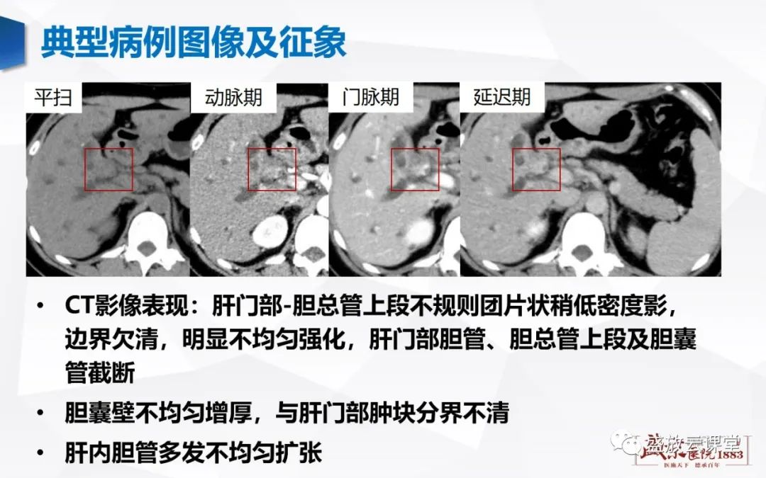 影像PPT - 【病例】胆囊癌及肝门部胆管癌各1例CT影像-13