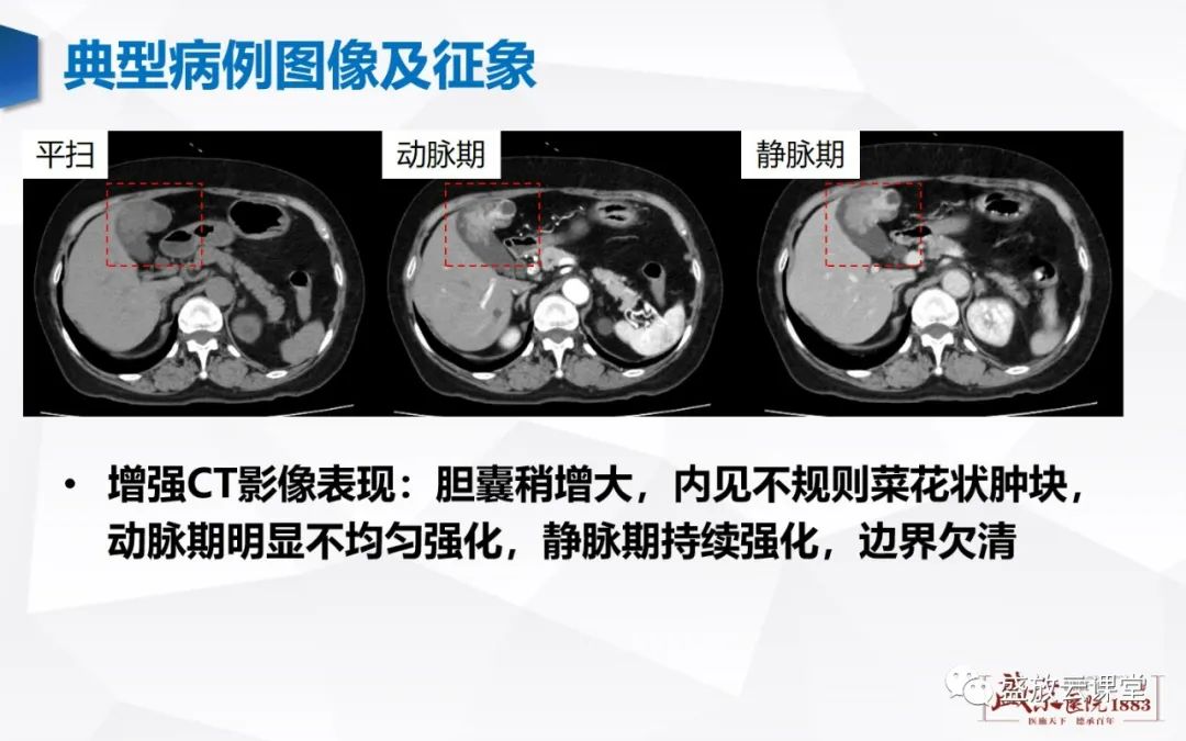 影像PPT - 【病例】胆囊癌及肝门部胆管癌各1例CT影像-4