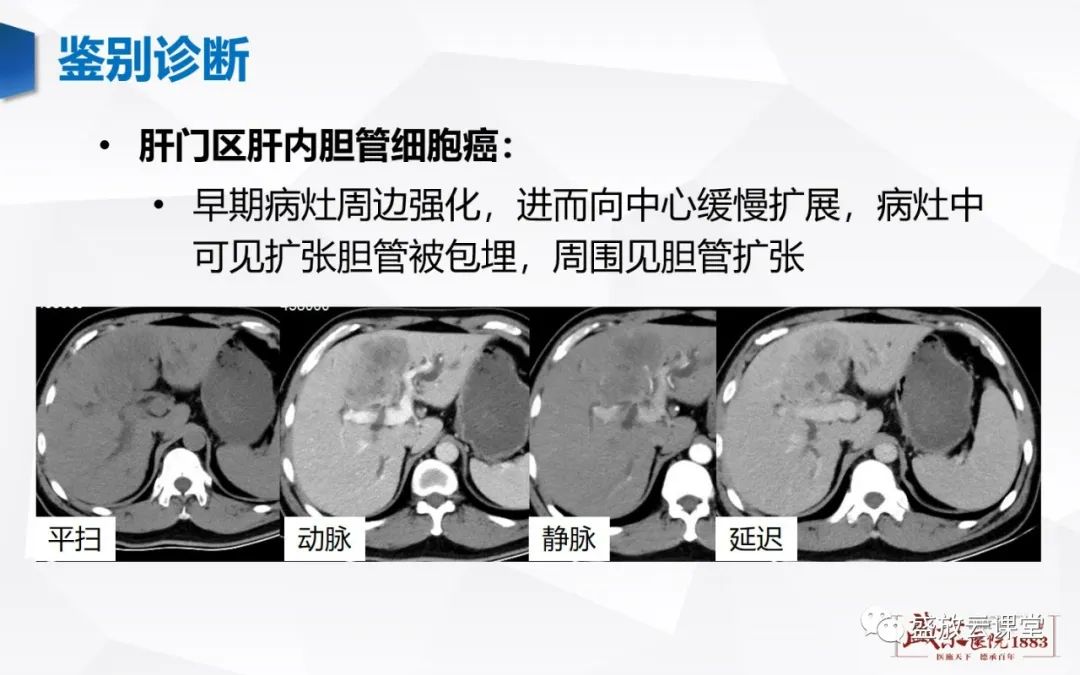 影像PPT - 【病例】胆囊癌及肝门部胆管癌各1例CT影像-20