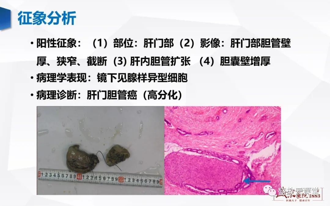 影像PPT - 【病例】胆囊癌及肝门部胆管癌各1例CT影像-17