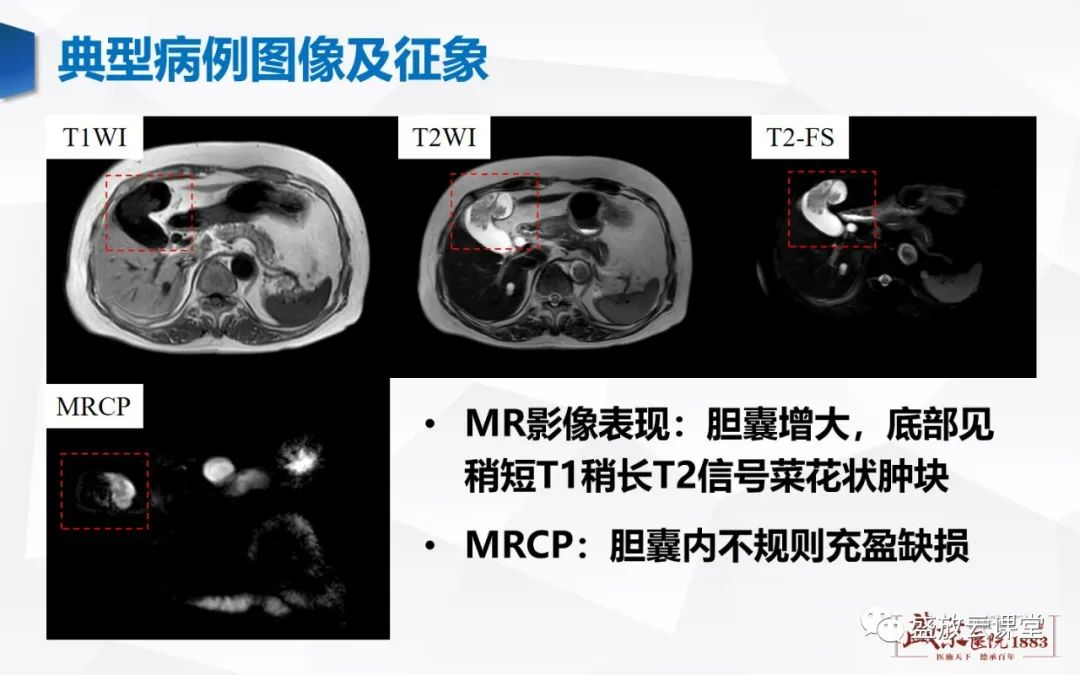 影像PPT - 【病例】胆囊癌及肝门部胆管癌各1例CT影像-2