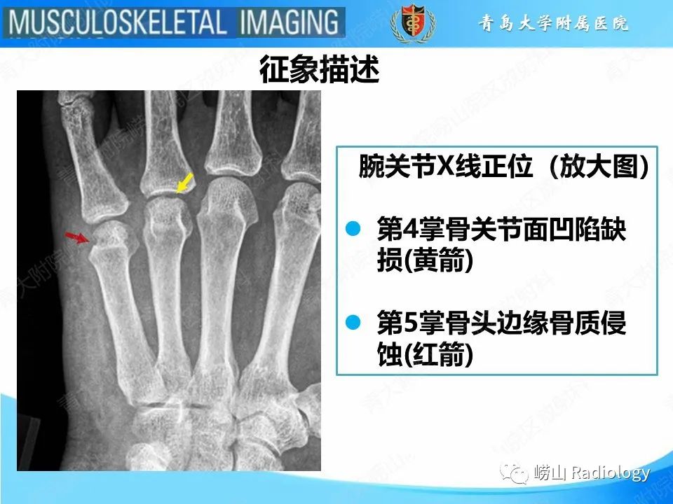 影像PPT - 【PPT】掌骨撞击牙齿骨折-11