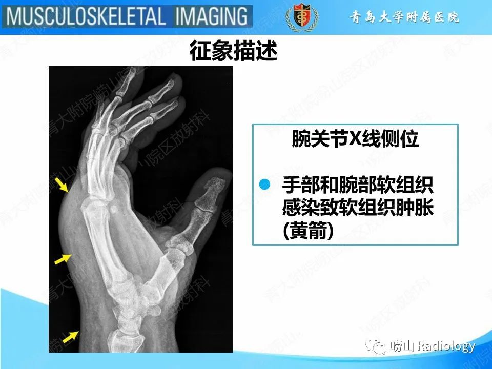 影像PPT - 【PPT】掌骨撞击牙齿骨折-12