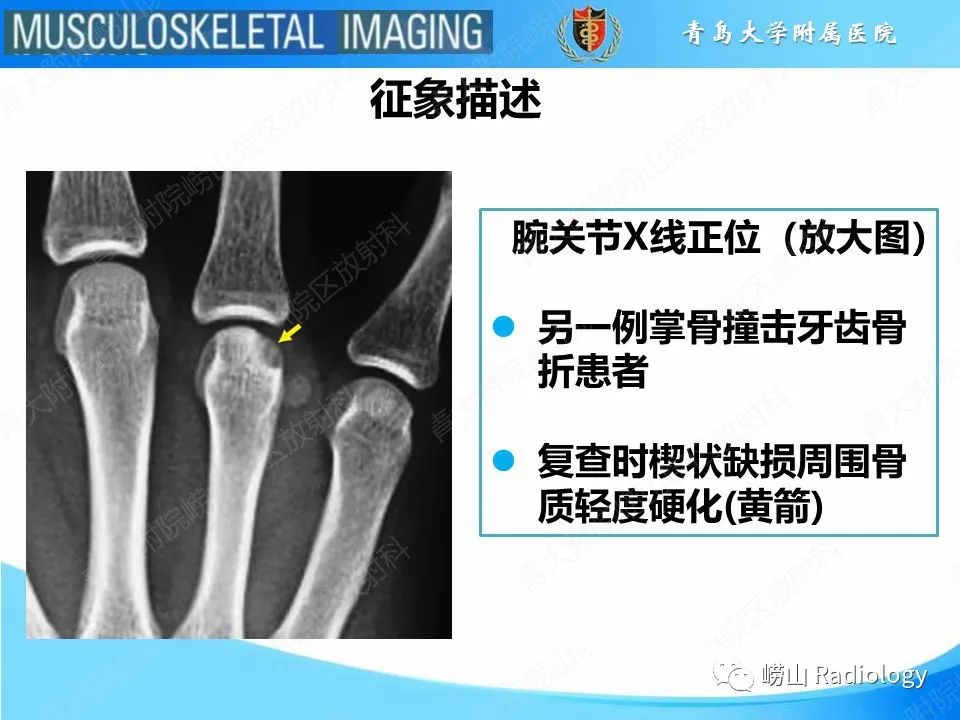 影像PPT - 【PPT】掌骨撞击牙齿骨折-14