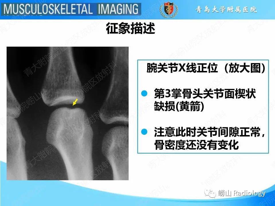 影像PPT - 【PPT】掌骨撞击牙齿骨折-13