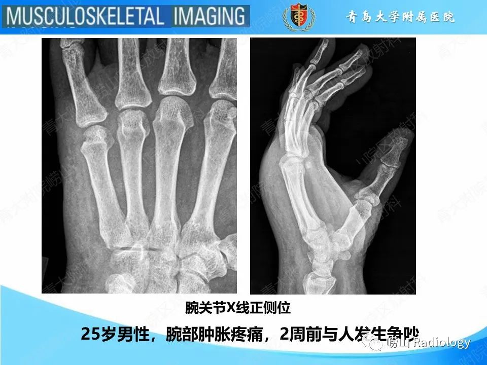 影像PPT - 【PPT】掌骨撞击牙齿骨折-2