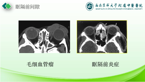 影像PPT - 【PPT】眼部常见疾病影像学定位诊断-6