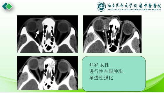 影像PPT - 【PPT】眼部常见疾病影像学定位诊断-12