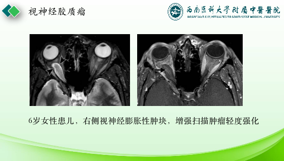影像PPT - 【PPT】眼部常见疾病影像学定位诊断-17