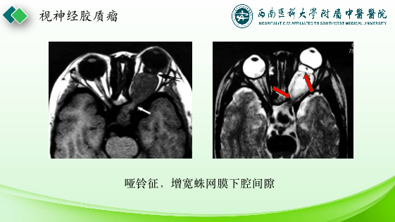 影像PPT - 【PPT】眼部常见疾病影像学定位诊断-18