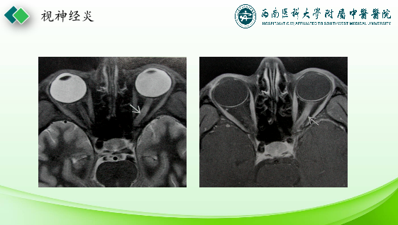 影像PPT - 【PPT】眼部常见疾病影像学定位诊断-19