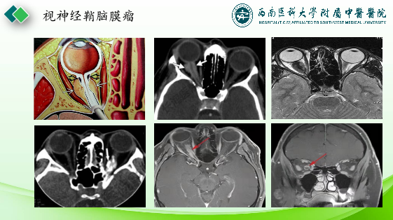 影像PPT - 【PPT】眼部常见疾病影像学定位诊断-15