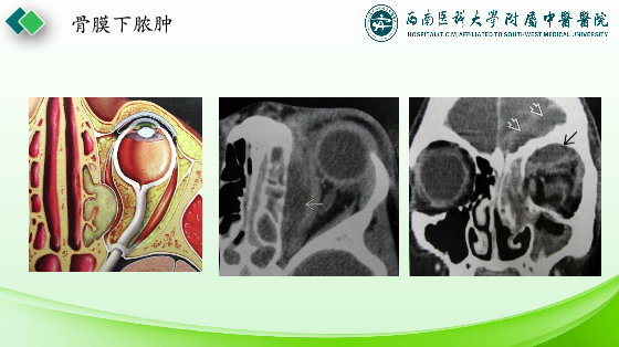 影像PPT - 【PPT】眼部常见疾病影像学定位诊断-27