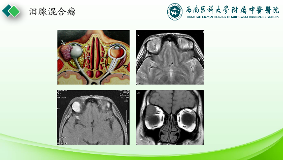 影像PPT - 【PPT】眼部常见疾病影像学定位诊断-31