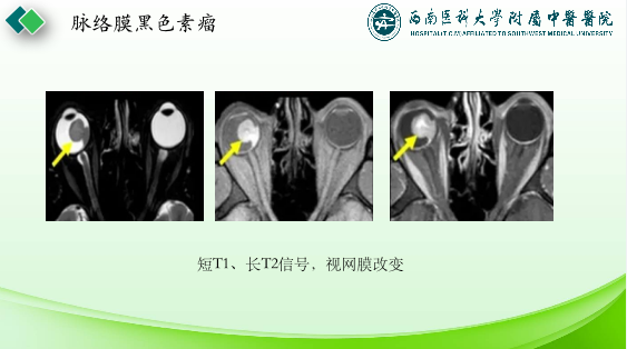 影像PPT - 【PPT】眼部常见疾病影像学定位诊断-42