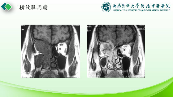 影像PPT - 【PPT】眼部常见疾病影像学定位诊断-46