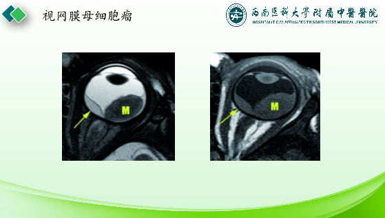 影像PPT - 【PPT】眼部常见疾病影像学定位诊断-39