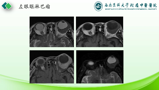 影像PPT - 【PPT】眼部常见疾病影像学定位诊断-45